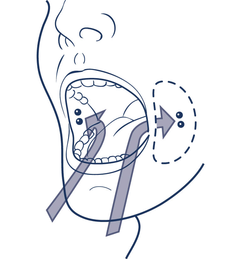 24 - 48 hours after taking mifepristone, you will take the misoprostol by placing 2 tablets in each cheek pocket (4 tablets total)